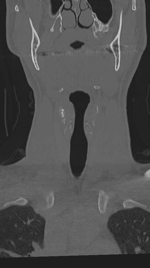 Cervical intercalary bone (Radiopaedia 35211-36748 Coronal bone window 12).png