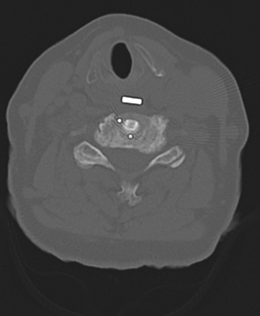 Cervical spine ACDF loosening (Radiopaedia 48998-54071 Axial bone window 36).png