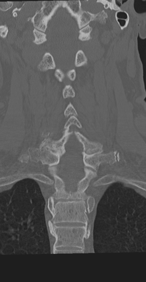 Cervical spine fracture in the setting of ankylosis (Radiopaedia 37038-38715 Coronal bone window 42).png