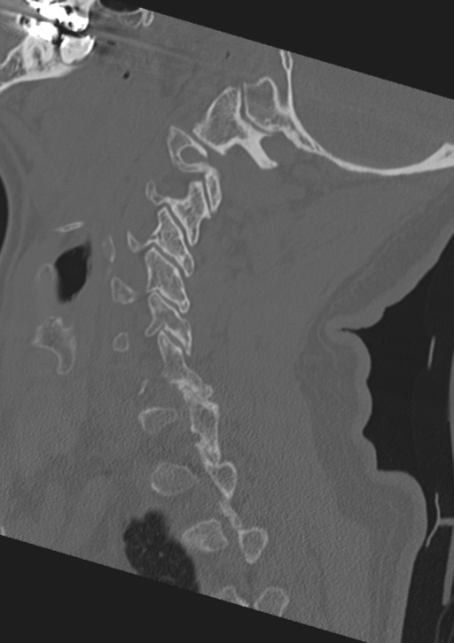 Cervical spine fractures with vertebral artery dissection (Radiopaedia 53296-59268 Sagittal bone window 20).png