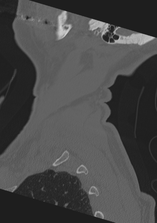 Cervical spine fractures with vertebral artery dissection (Radiopaedia 53296-59268 Sagittal bone window 68).png
