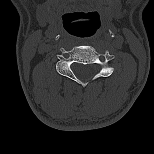 Cervical spondylodiscitis (Radiopaedia 28057-29489 Axial bone window 34).jpg
