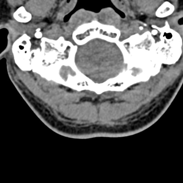 Cervical spondylodiscitis (Radiopaedia 28057-29489 Axial non-contrast 10).jpg