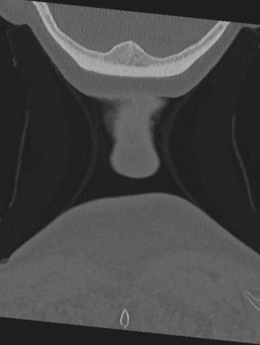 Cervical spondylolysis (Radiopaedia 49616-54811 Coronal bone window 72).png