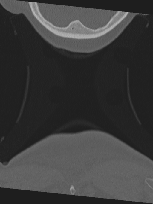 Cervical spondylolysis (Radiopaedia 49616-54811 Coronal bone window 78).png
