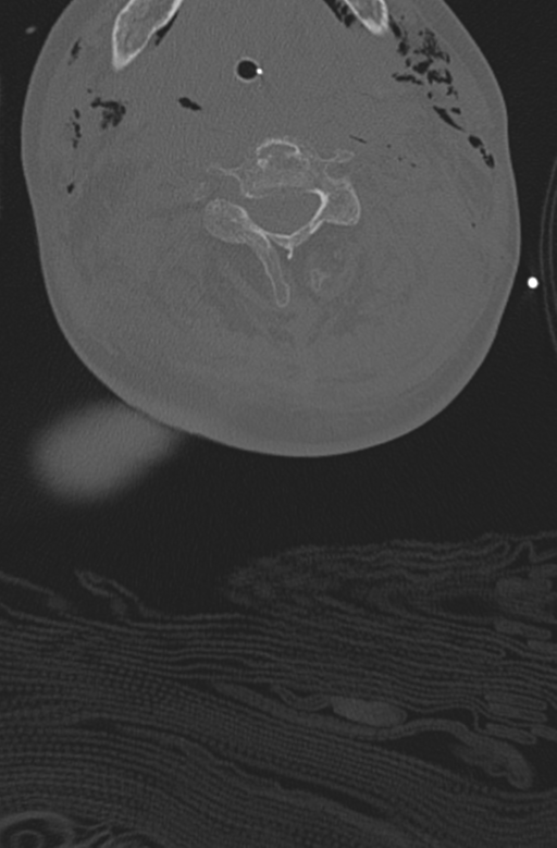 Chalk stick fracture (Radiopaedia 57948-64928 Axial bone window 26).png