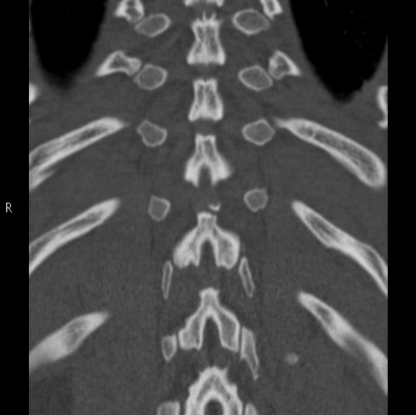 Chance fracture (Radiopaedia 36521-38081 Coronal bone window 51).jpg