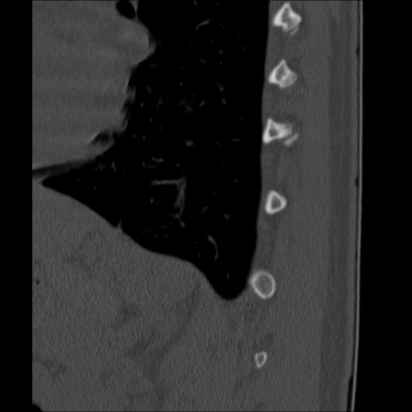 Chance fracture (Radiopaedia 36521-38081 Sagittal bone window 64).jpg