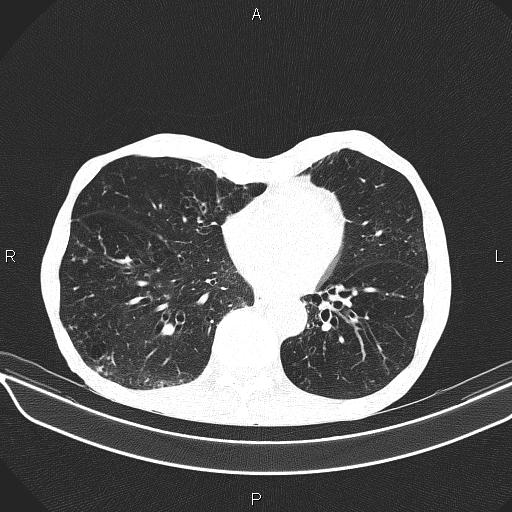 Chilaiditi sign (Radiopaedia 88839-105611 Axial lung window 60).jpg