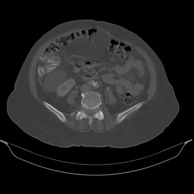 Cholangiocarcinoma (Radiopaedia 50592-56025 Axial bone window 44).jpg