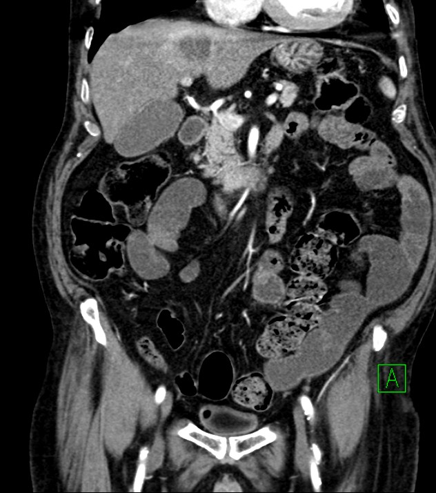 Cholangiocarcinoma with cerebral metastases (Radiopaedia 83519-98629 E 39).jpg
