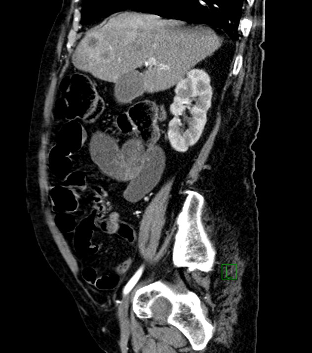 Cholangiocarcinoma with cerebral metastases (Radiopaedia 83519-98629 F 83).jpg