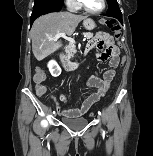 File:Cholecystoduodenal fistula due to calculous cholecystitis with gallstone migration (Radiopaedia 86875-103077 B 20).jpg