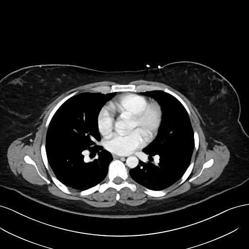 File:Choledocholithiasis after recent cholecystectomy (Radiopaedia 60929-68737 Axial 81).jpg