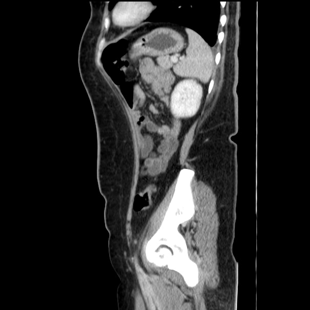 Choledocholithiasis on CT and MRI (Radiopaedia 24825-25087 D 48).jpg