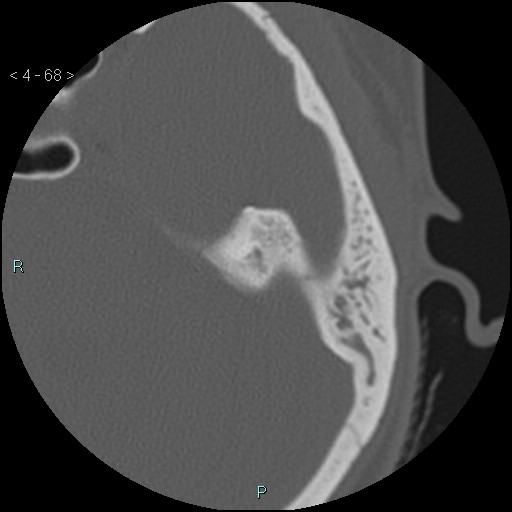File:Cholesterol granuloma of the petrous apex (Radiopaedia 64358-73141 Axial bone window 33).jpg