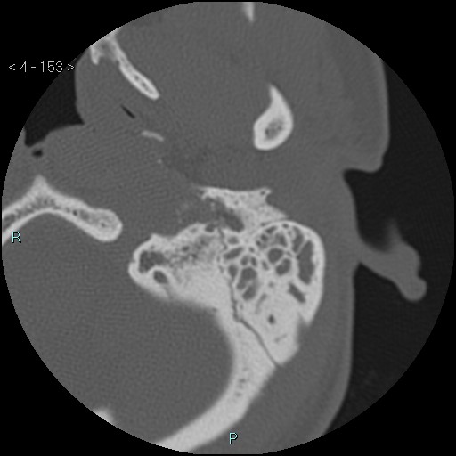 File:Cholesterol granuloma of the petrous apex (Radiopaedia 64358-73141 Axial bone window 74).jpg