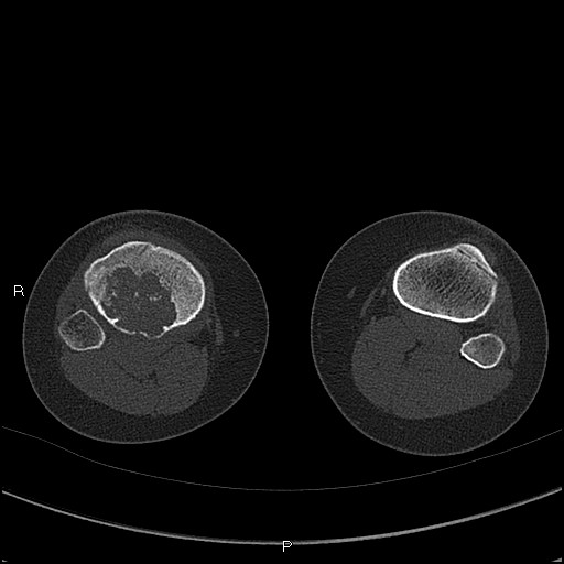 Chondroblastoma (Radiopaedia 62721-71030 Axial bone window 74).jpg