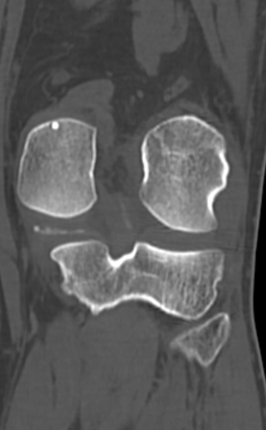 Chondrocalcinosis (Radiopaedia 82862-97173 Coronal bone window 56).jpg
