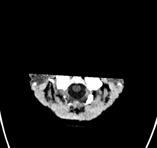 File:Chondrosarcoma (Radiopaedia 41937-44940 Axial non-contrast 2).png
