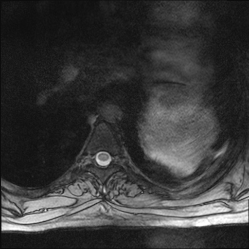 File:Chondrosarcoma - chest wall (Radiopaedia 65192-74200 Axial Gradient Echo 31).jpg