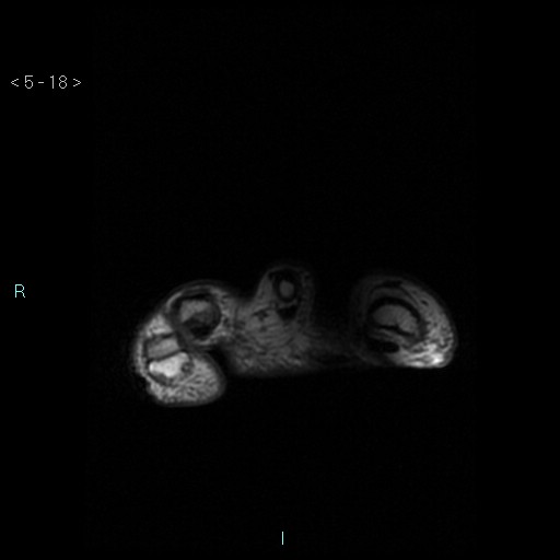 File:Chondrosarcoma - phalanx (Radiopaedia 69047-78813 Axial T1 18).jpg