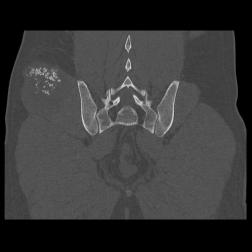 Chondrosarcoma of iliac wing (Radiopaedia 63861-72599 Coronal bone window 89).jpg
