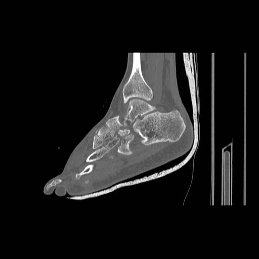 File:Chopart fracture (Radiopaedia 12386-12650 Sagittal bone window 17).jpg