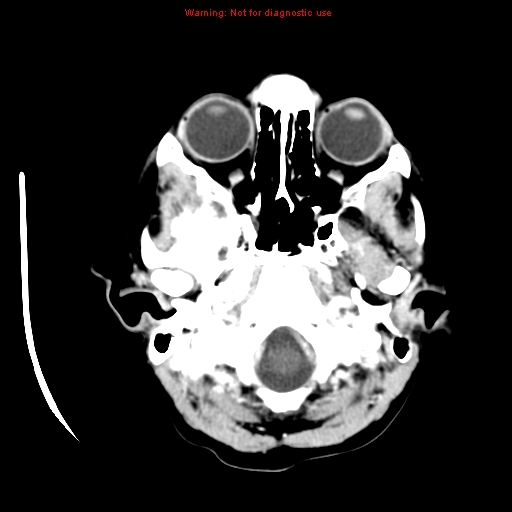 File:Choroid plexus carcinoma - recurrent (Radiopaedia 8330-9168 B 2).jpg