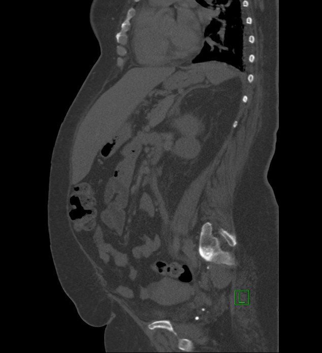 Chromophobe renal cell carcinoma (Radiopaedia 84239-99519 Sagittal bone window 43).jpg