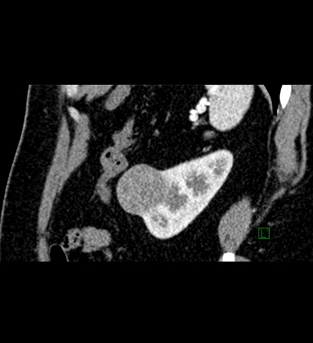 Chromophobe renal cell carcinoma (Radiopaedia 84286-99573 F 33).jpg