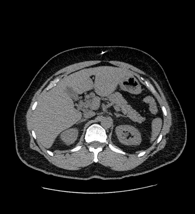 Chromophobe renal cell carcinoma (Radiopaedia 84337-99693 Axial non-contrast 37).jpg