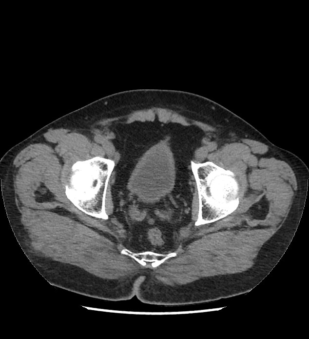 Chromophobe renal cell carcinoma (Radiopaedia 86879-103083 Axial non-contrast 120).jpg
