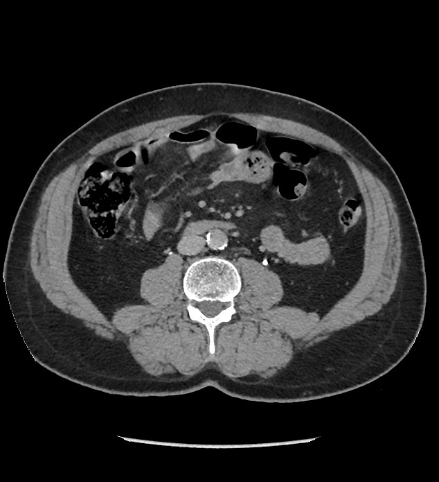 Chromophobe renal cell carcinoma (Radiopaedia 86879-103083 D 80).jpg
