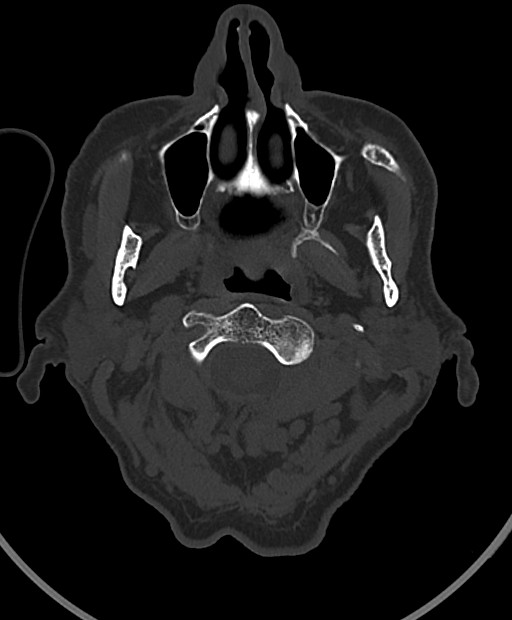 Chronic bilateral subdural hygroma (Radiopaedia 85801-101623 Axial bone window 120).jpg