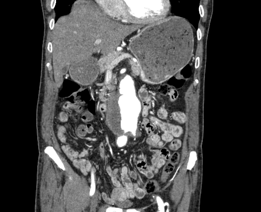 File:Chronic contained rupture of abdominal aortic aneurysm with extensive erosion of the vertebral bodies (Radiopaedia 55450-61901 D 19).jpg