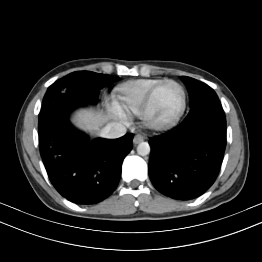 Chronic eosinophilic pneumonia (Radiopaedia 39331-41587 Axial C+ delayed 80).png