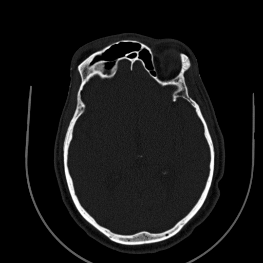 Chronic invasive fungal sinusitis (Radiopaedia 91563-109286 Axial sinus 124).jpg