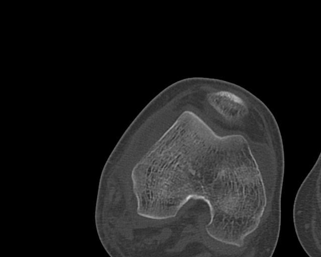Chronic ostemyelitis of the femur with long sinus tract (Radiopaedia 74947-85982 Axial bone window 217).jpg