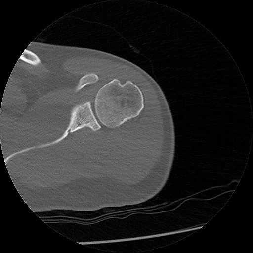 File:Chronic osteomyelitis (Radiopaedia 67597-76998 Axial bone window 7).jpg