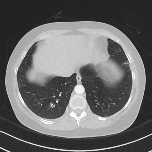 Chronic pulmonary embolus (Radiopaedia 39129-41341 Axial lung window 49).png