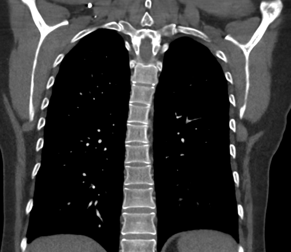 Chronic pulmonary embolus (Radiopaedia 39129-41341 Coronal C+ CTPA 62).png