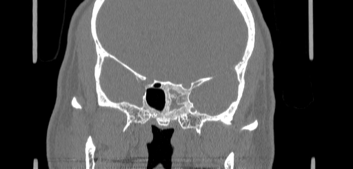 Chronic sphenoidal sinusitis (Radiopaedia 62030-70122 Coronal bone window 114).jpg