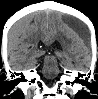 Chronic subdural hematomas (Radiopaedia 66577-75885 Coronal non-contrast 36).jpg