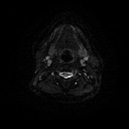 Chronic submandibular sialadenitis (Radiopaedia 61852-69885 Axial DWI 44).jpg