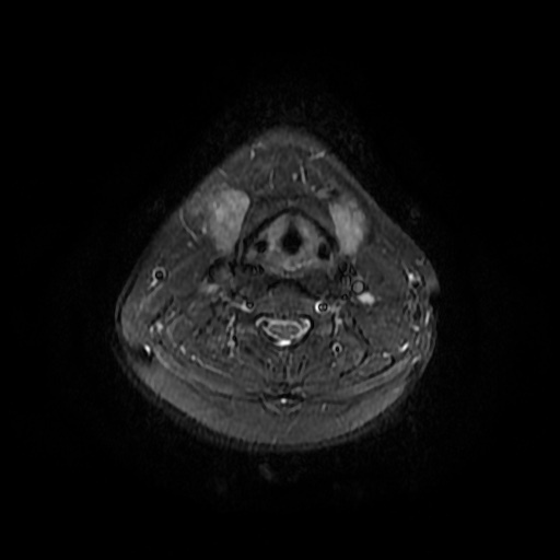 File:Chronic submandibular sialadenitis (Radiopaedia 61852-69885 Axial STIR 18).jpg