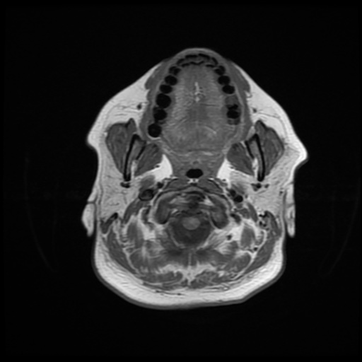 File:Chronic submandibular sialadenitis (Radiopaedia 61852-69885 Axial T1 8).jpg