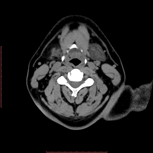 File:Chronic submandibular sialolithiasis (Radiopaedia 69817-79814 Axial non-contrast 136).jpg