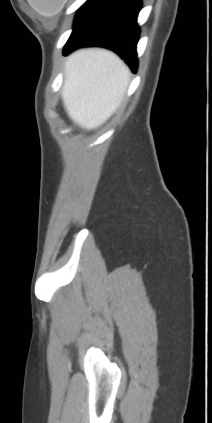 Circumaortic left renal vein with a duplicated retroaortic vein (Radiopaedia 91668-109398 C 8).jpg