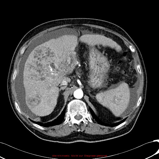 File:Cirrhosis and hepatocellular carcinoma in the setting of hemochromatosis (Radiopaedia 75394-86595 A 28).jpg